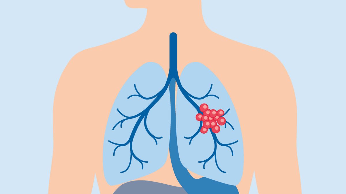 lung cancer